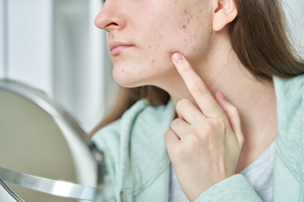 Woman stressed about her stressed skin