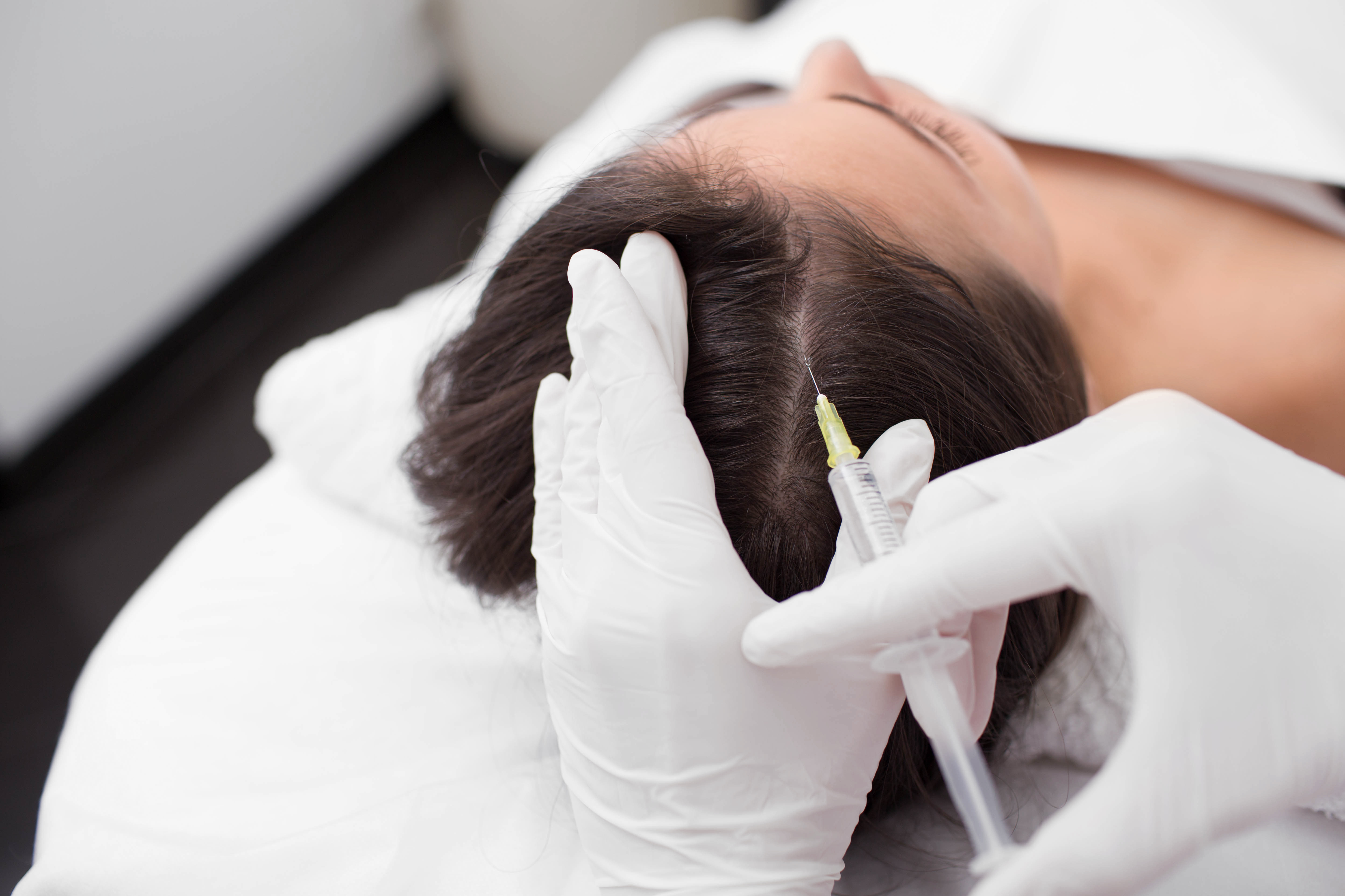 Mesotherapy for hair loss